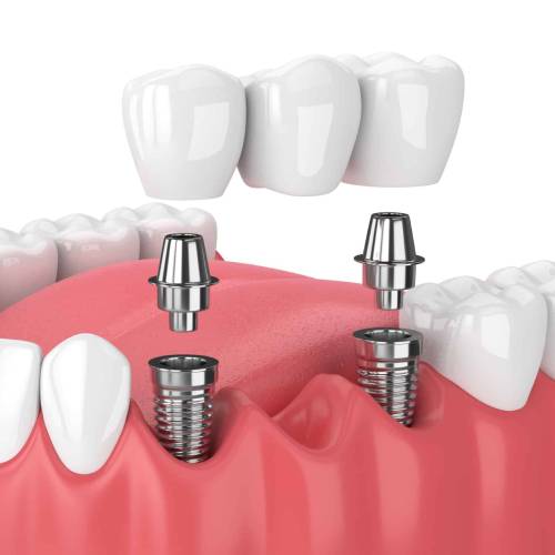 Dental Bridges