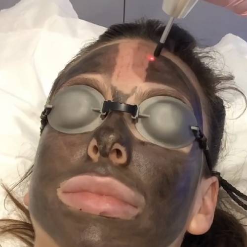 Carbon Facial in Delhi