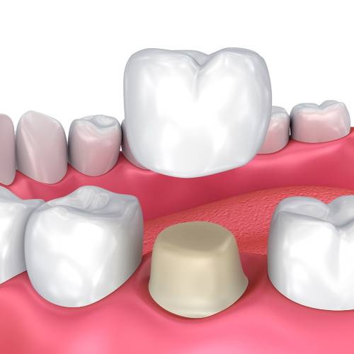 Dental Crown