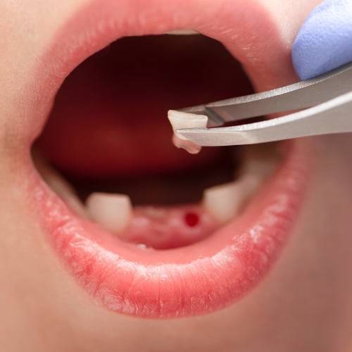 Dental Extraction