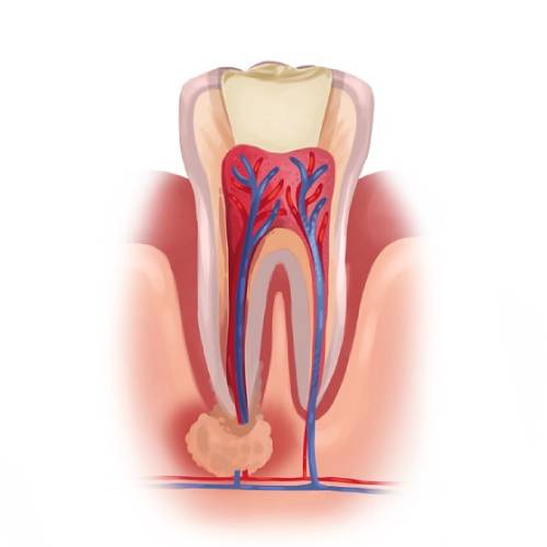 Root Canal Treatment