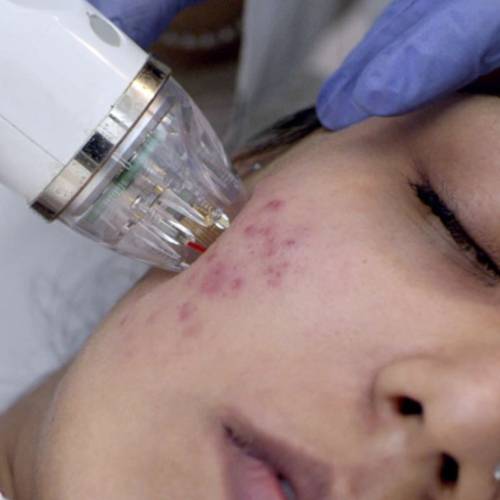 Scar Removal Treatment in Delhi