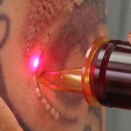 Tattoo Removal Removal Services in Delhi