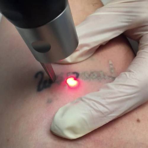 Tattoo Removal Removal Services in West Delhi