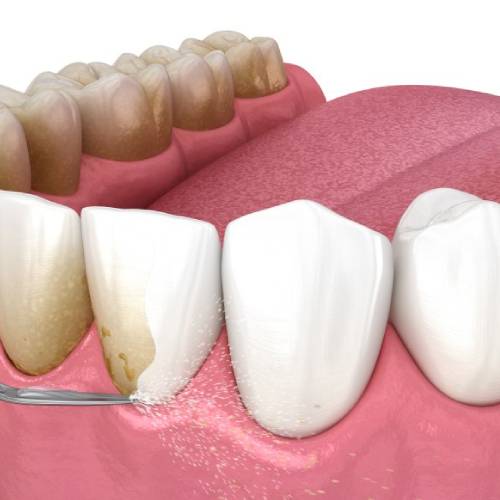 Tooth Scaling