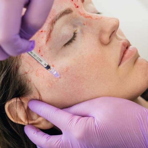 Vampire Facial in Delhi