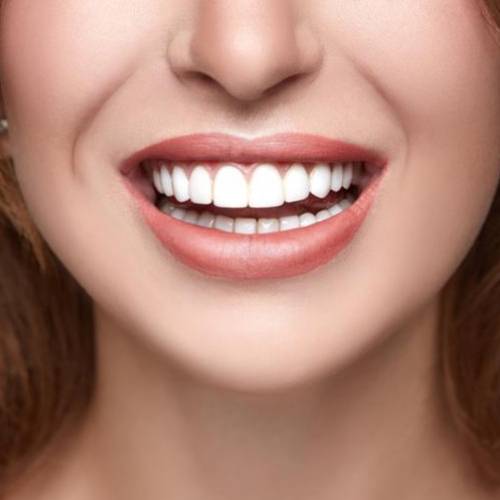 Veneers